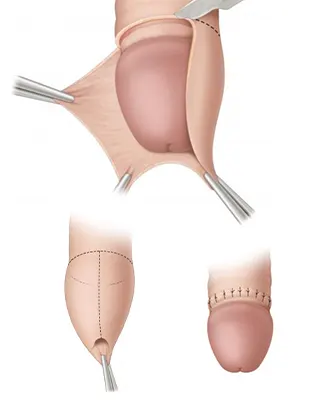 img-circuncision-en-bogota-1-LCP