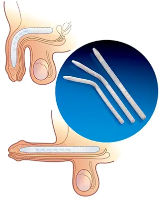 img-protesis-de-pene-en-bogota-1-LCP
