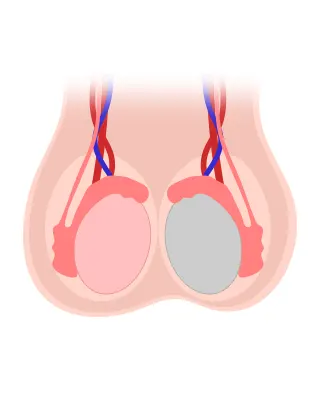 img-protesis-testicular-en-bogota-1-LCP